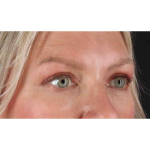 Eyelid Surgery Before & After Patient #1902