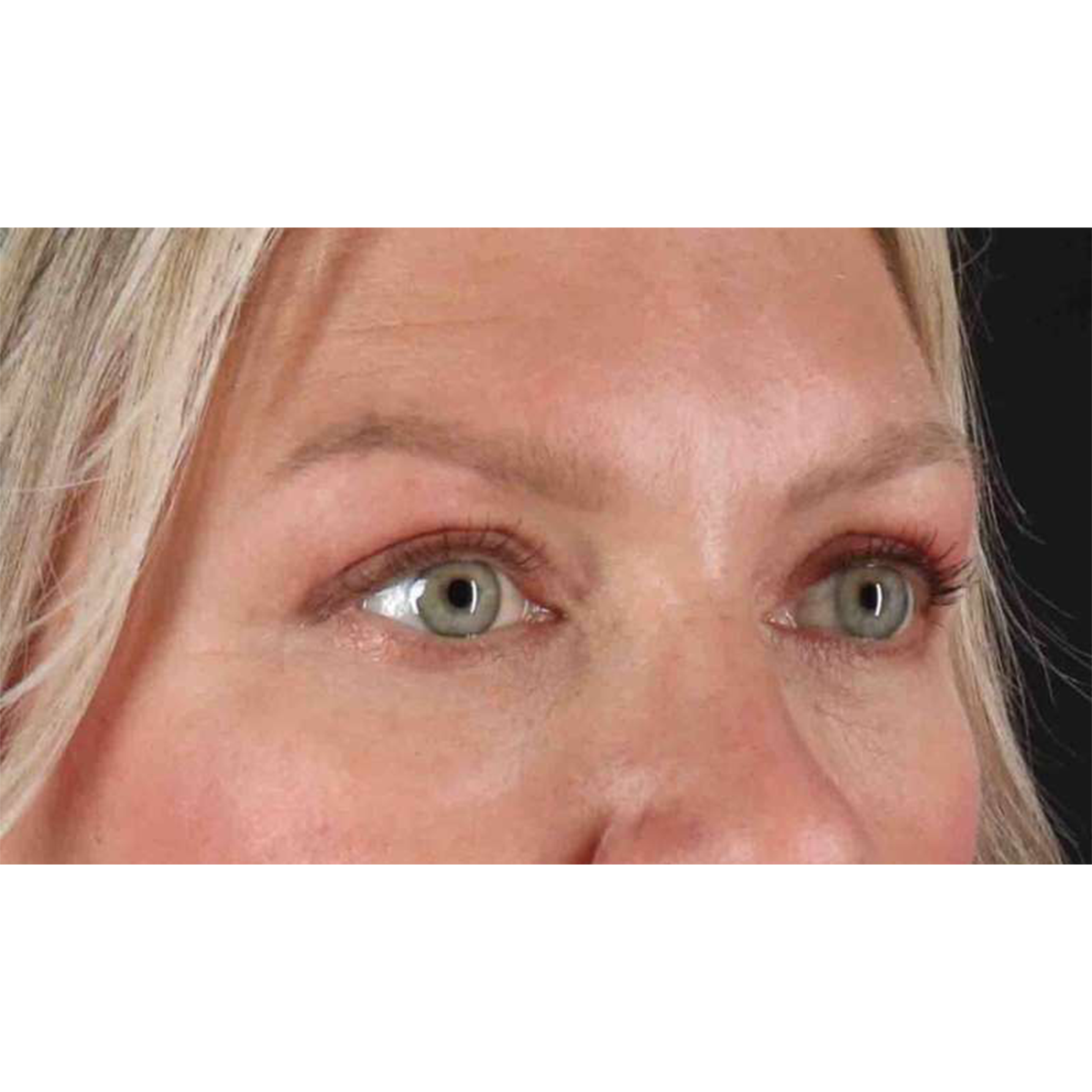 Eyelid Surgery Before & After Patient #1902