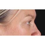 Eyelid Surgery Before & After Patient #1902