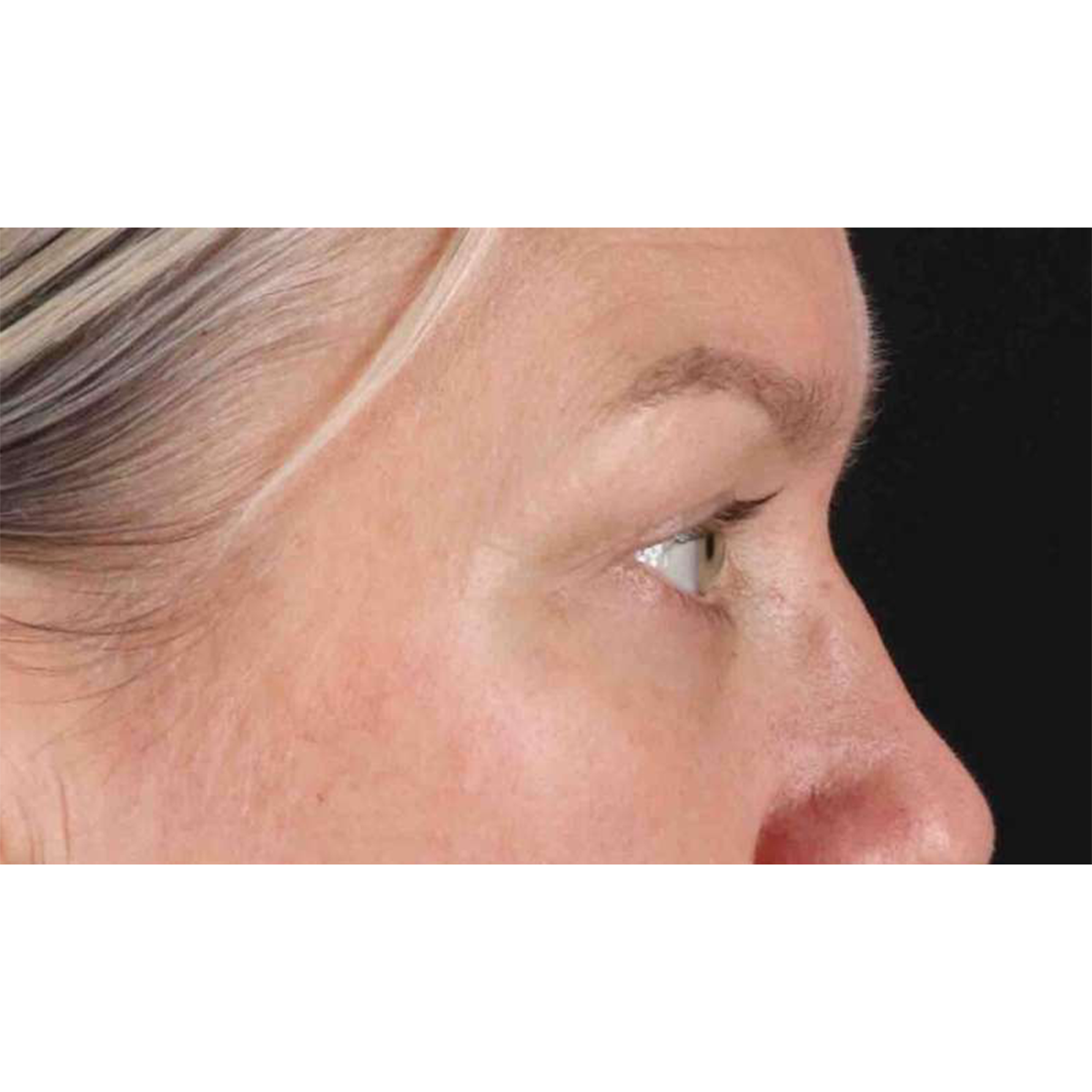 Eyelid Surgery Before & After Patient #1902