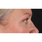 Eyelid Surgery Before & After Patient #1902