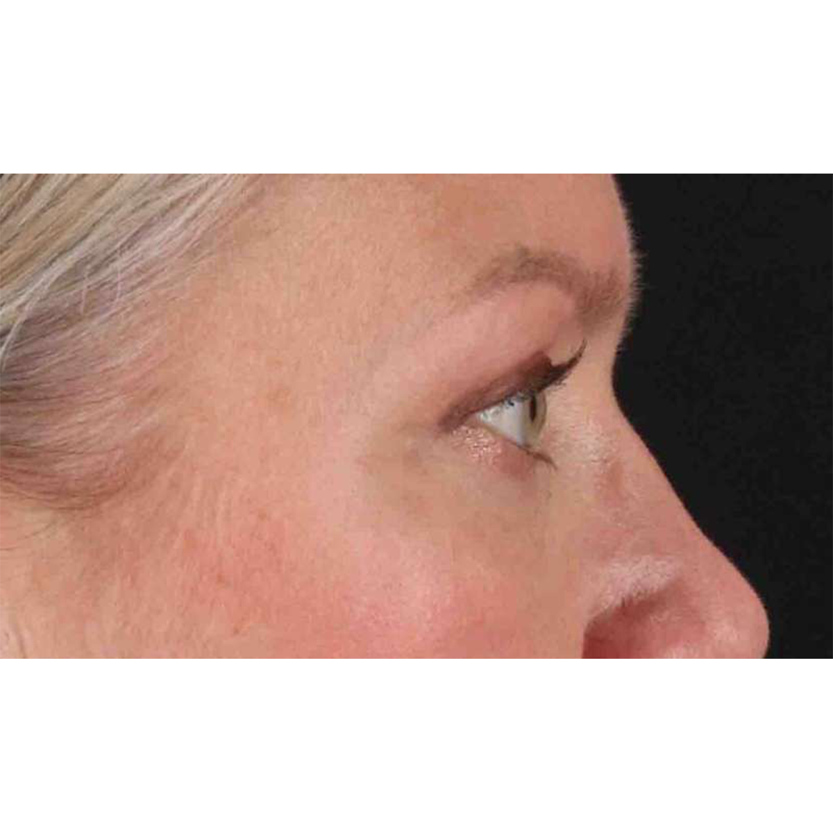 Eyelid Surgery Before & After Patient #1902
