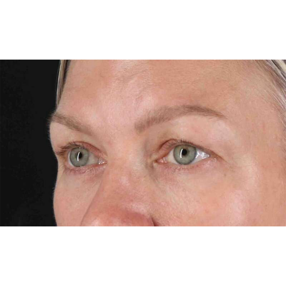 Eyelid Surgery Before & After Patient #1902