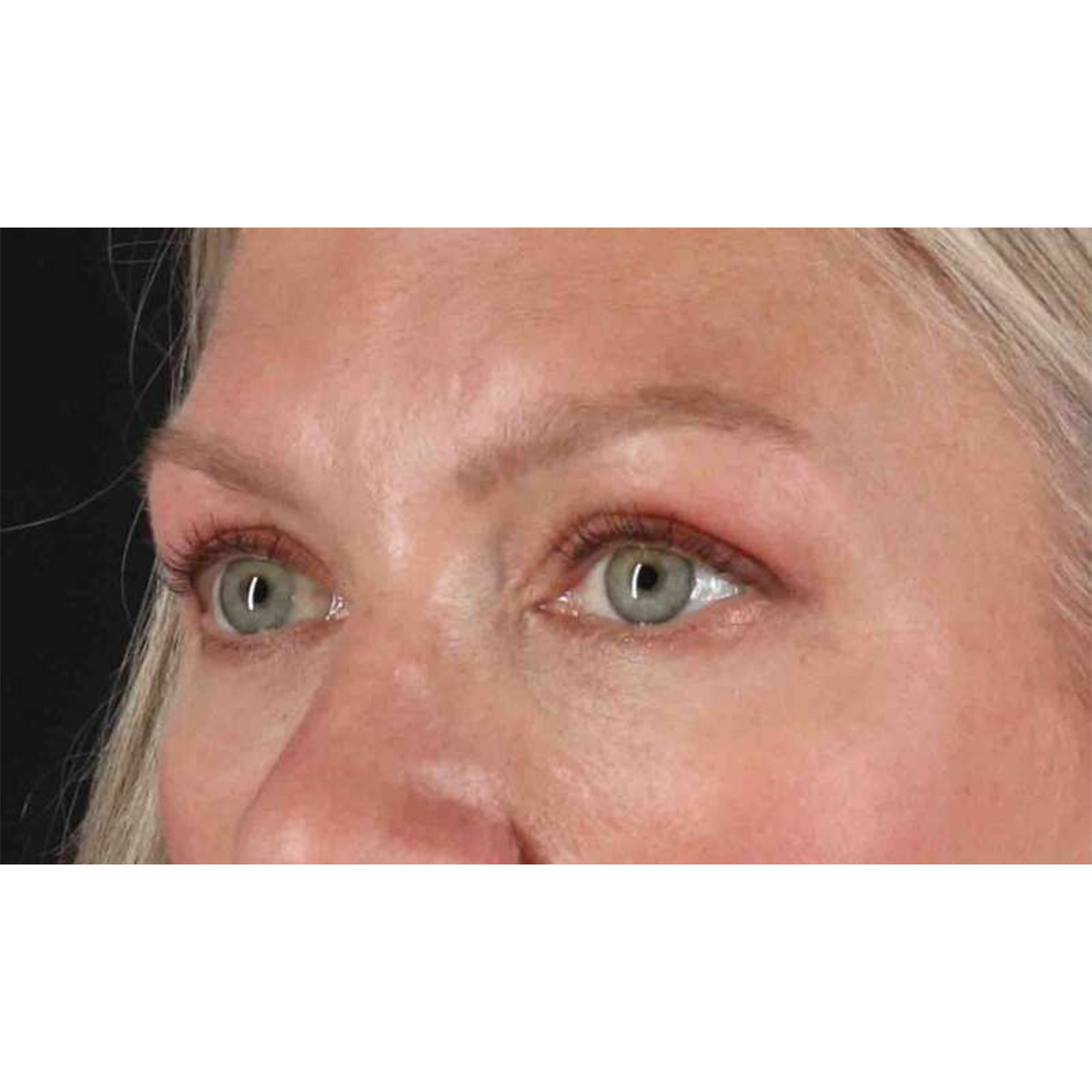 Eyelid Surgery Before & After Patient #1902