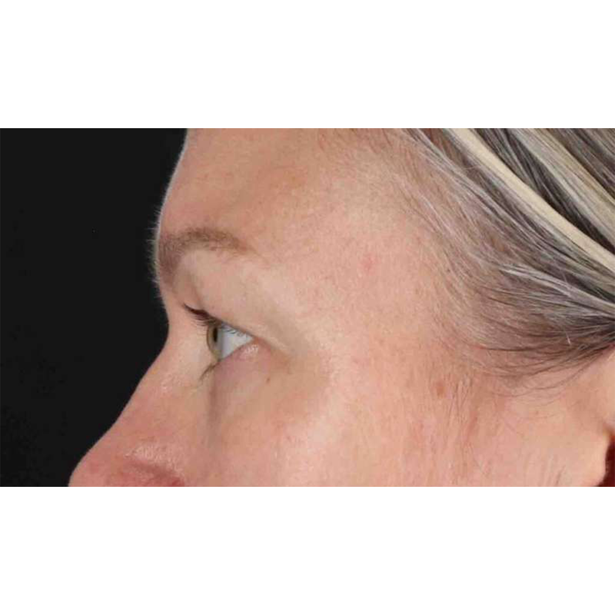 Eyelid Surgery Before & After Patient #1902