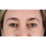 Eyelid Surgery Before & After Patient #1913