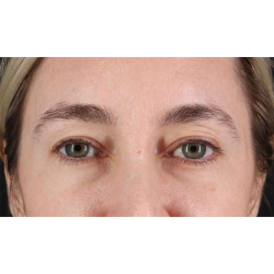 Eyelid Surgery Before & After Patient #1913