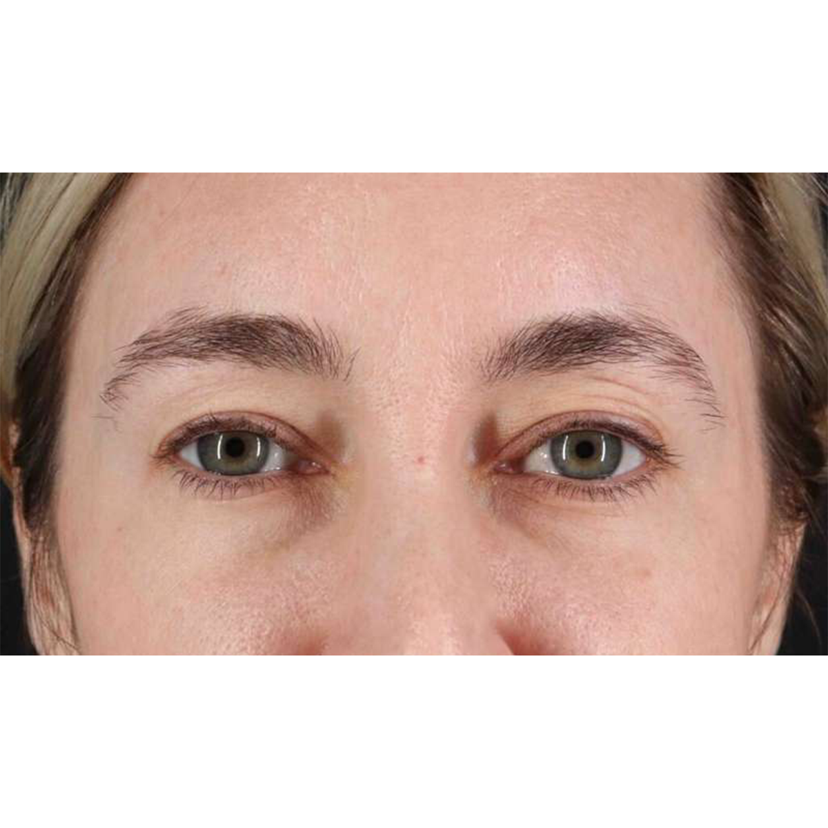 Eyelid Surgery Before & After Patient #1913
