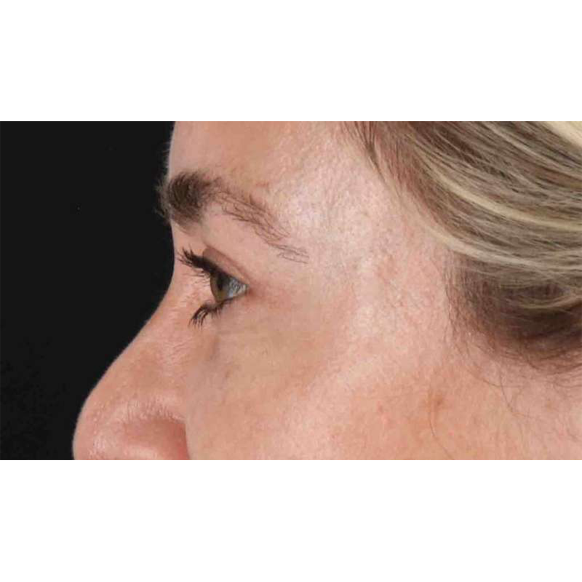 Eyelid Surgery Before & After Patient #1913