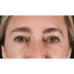 Eyelid Surgery Before & After Patient #1913