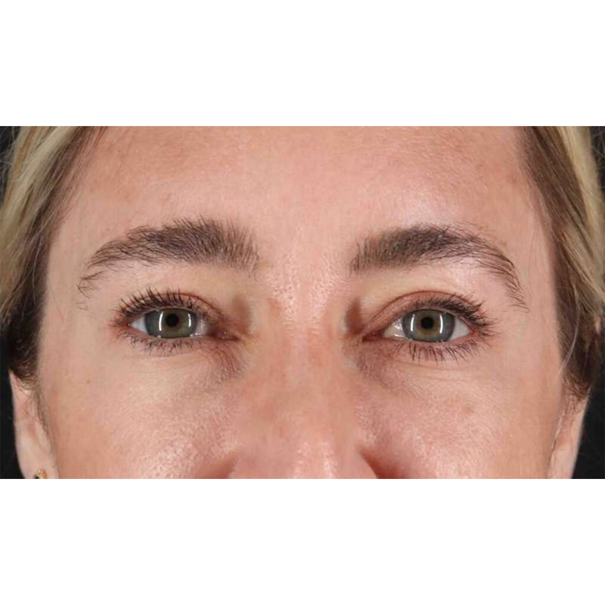 Eyelid Surgery Before & After Patient #1913