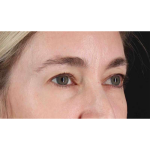 Eyelid Surgery Before & After Patient #1913