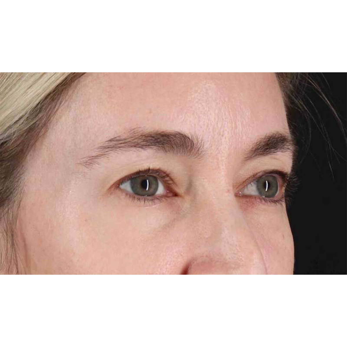 Eyelid Surgery Before & After Patient #1913