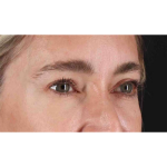 Eyelid Surgery Before & After Patient #1913