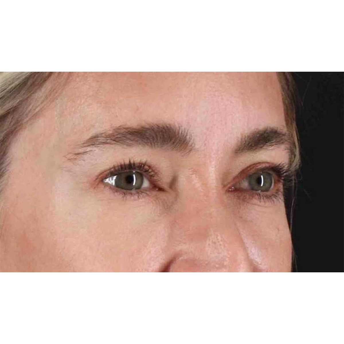 Eyelid Surgery Before & After Patient #1913