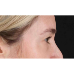 Eyelid Surgery Before & After Patient #1913