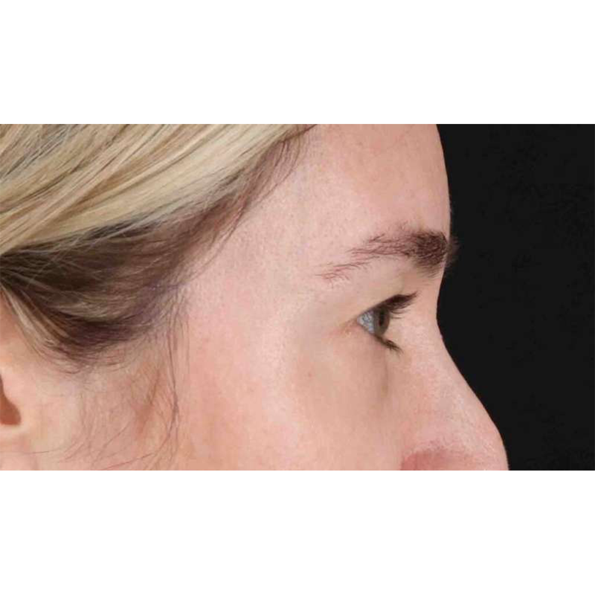 Eyelid Surgery Before & After Patient #1913