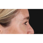 Eyelid Surgery Before & After Patient #1913