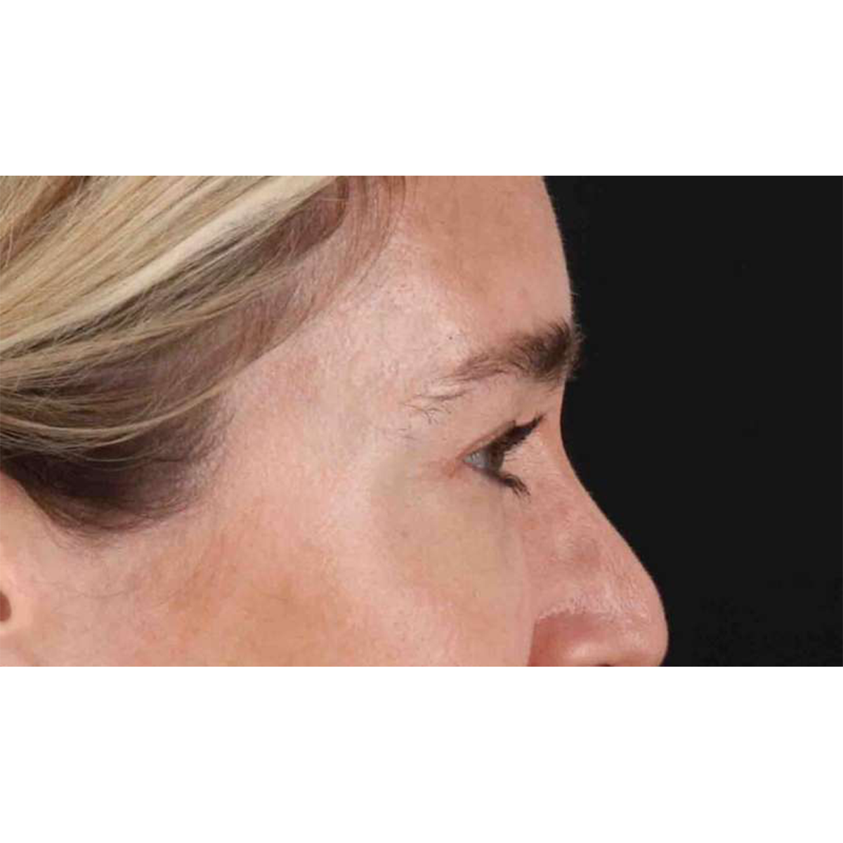 Eyelid Surgery Before & After Patient #1913