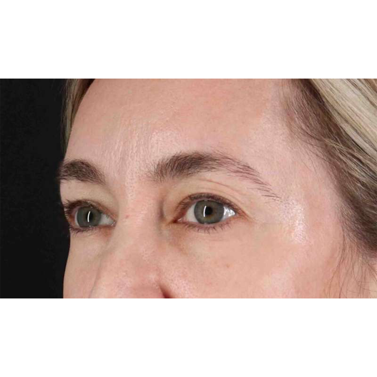 Eyelid Surgery Before & After Patient #1913