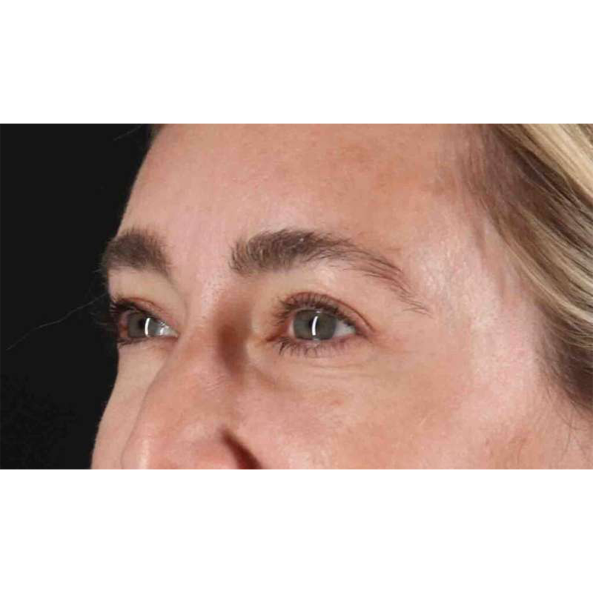 Eyelid Surgery Before & After Patient #1913