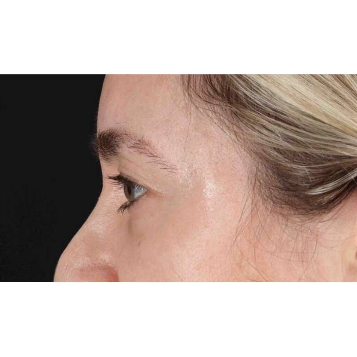 Eyelid Surgery Before & After Patient #1913