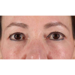 Eyelid Surgery Before & After Patient #1924