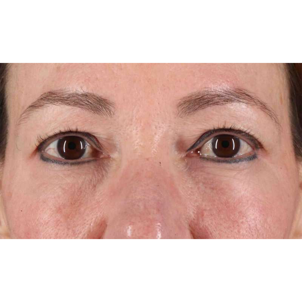 Eyelid Surgery Before & After Patient #1924