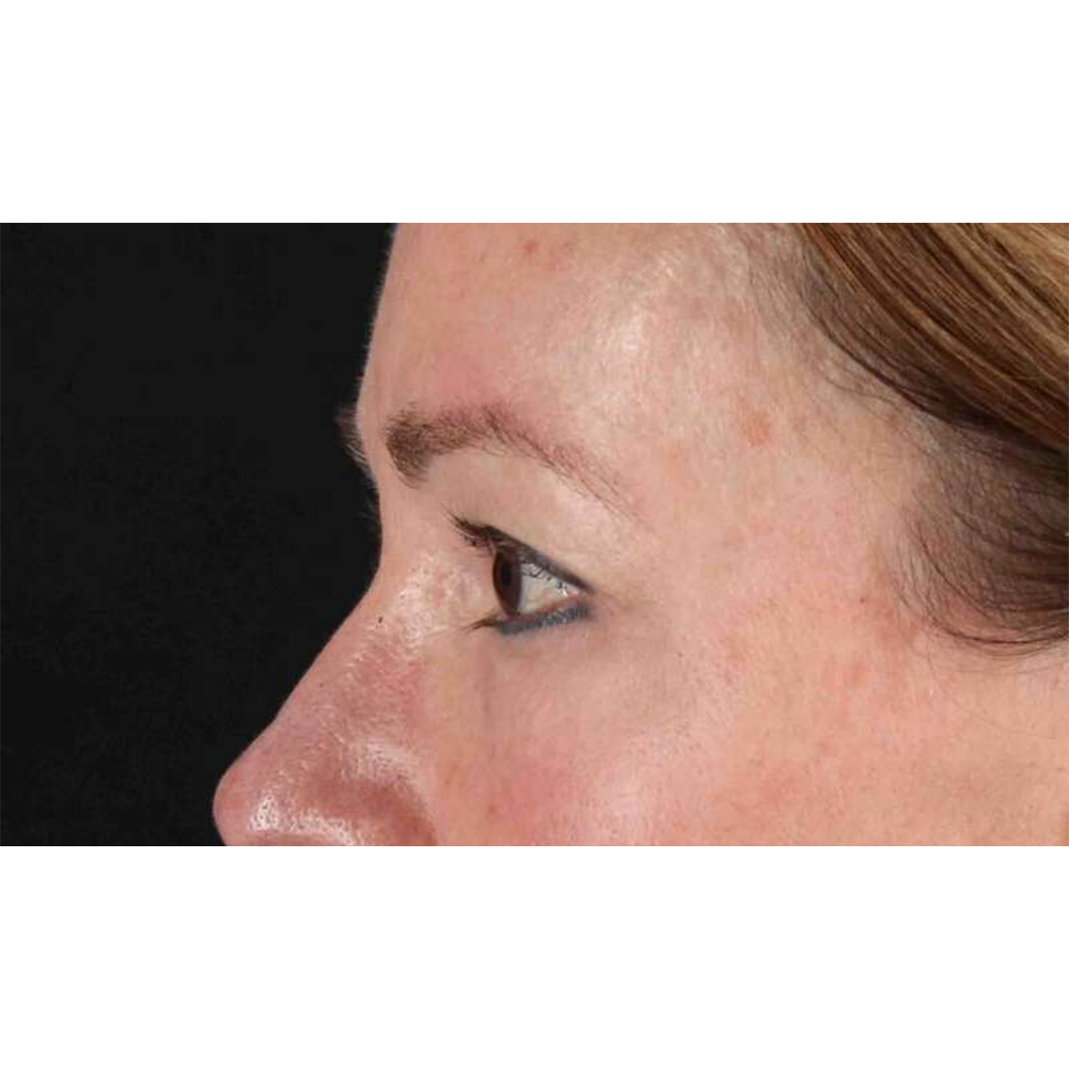 Eyelid Surgery Before & After Patient #1924
