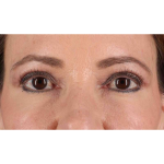 Eyelid Surgery Before & After Patient #1924