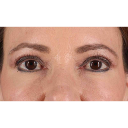 Eyelid Surgery Before & After Patient #1924
