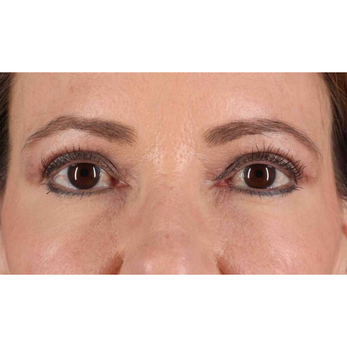 Eyelid Surgery Before & After Patient #1924