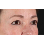 Eyelid Surgery Before & After Patient #1924