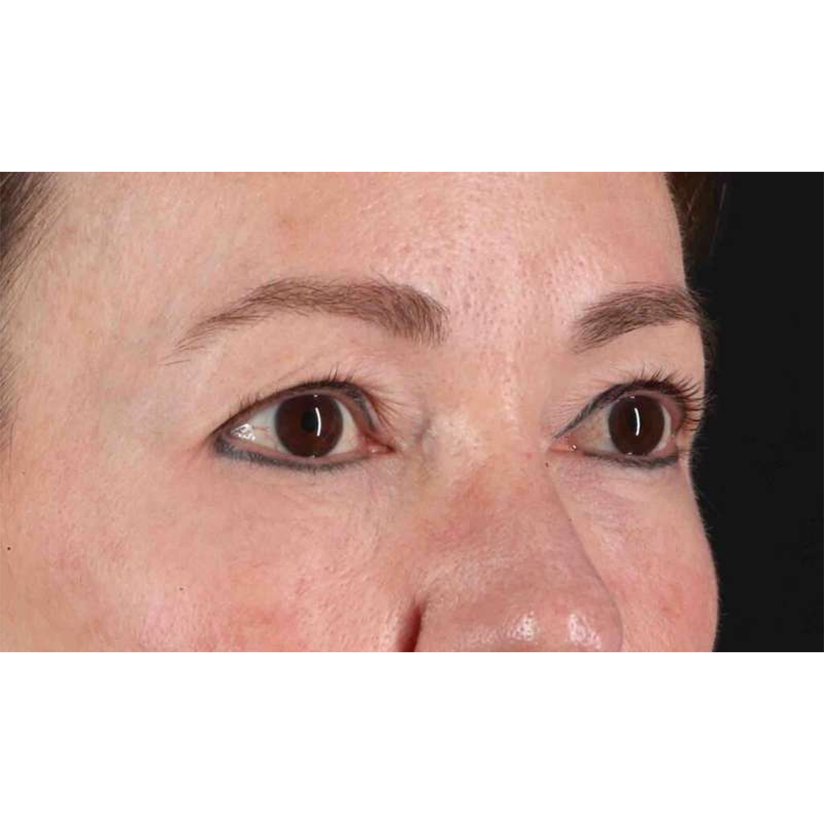 Eyelid Surgery Before & After Patient #1924