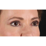 Eyelid Surgery Before & After Patient #1924