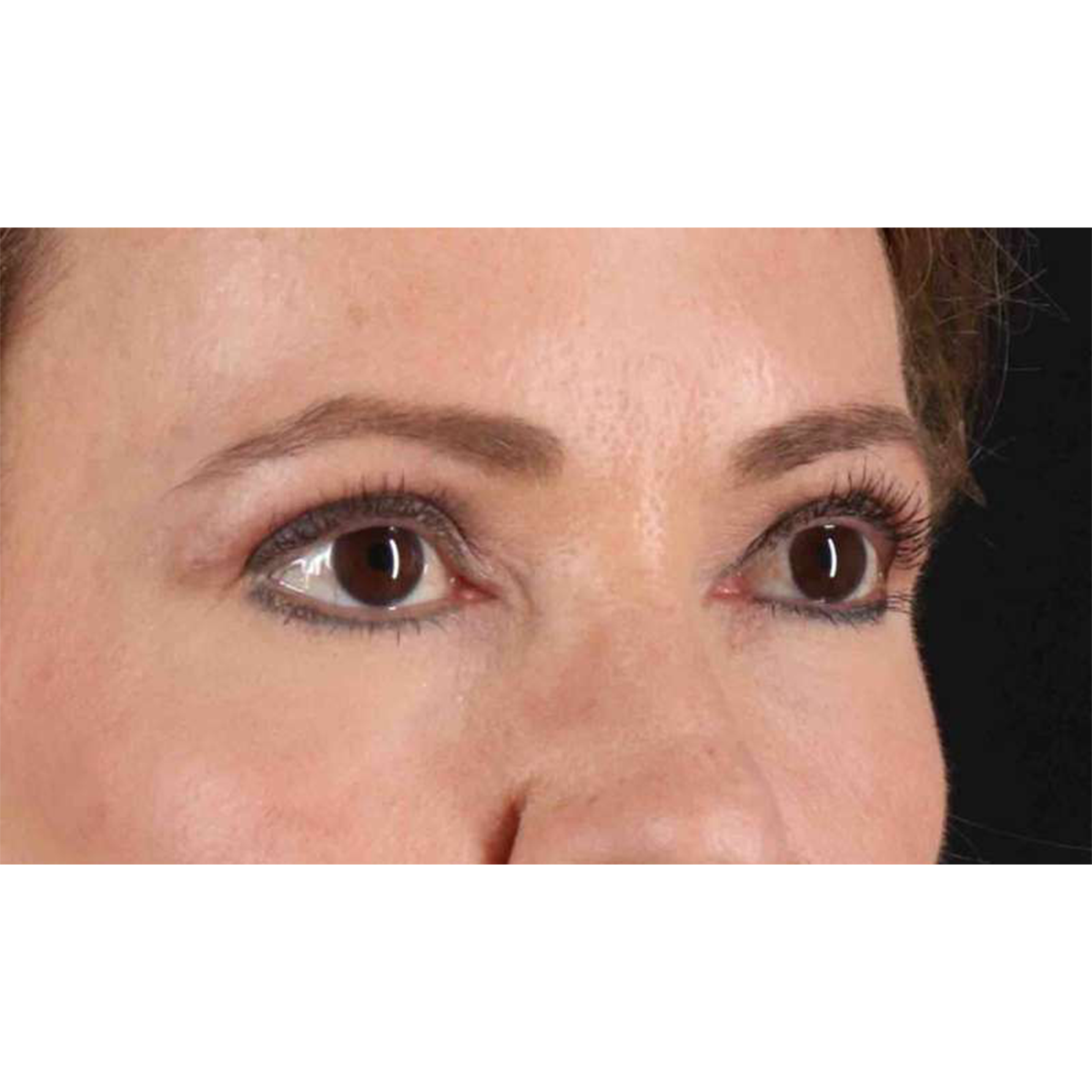 Eyelid Surgery Before & After Patient #1924