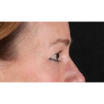 Eyelid Surgery Before & After Patient #1924