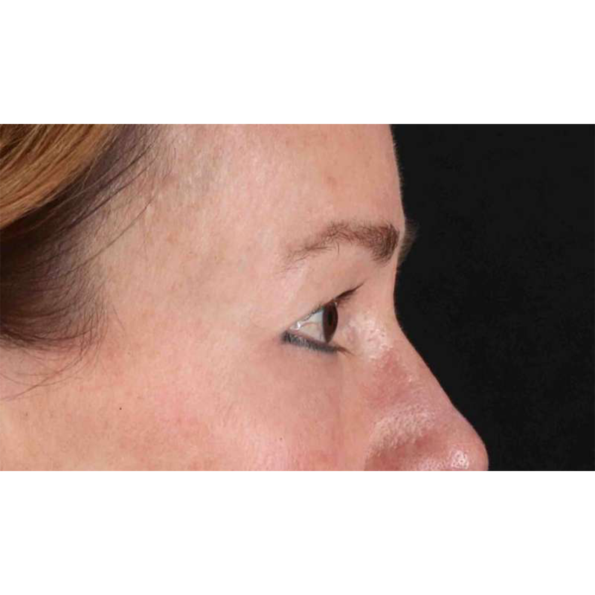 Eyelid Surgery Before & After Patient #1924
