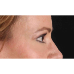 Eyelid Surgery Before & After Patient #1924