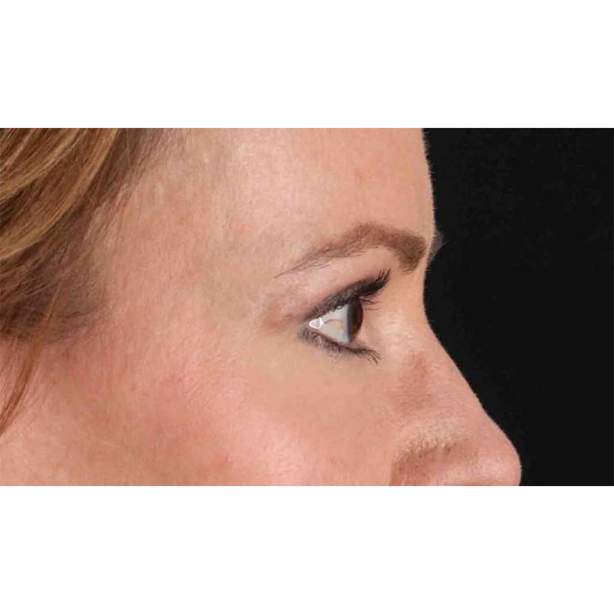 Eyelid Surgery Before & After Patient #1924