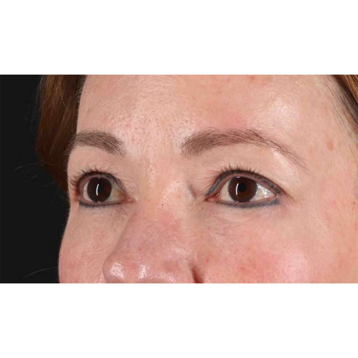 Eyelid Surgery Before & After Patient #1924