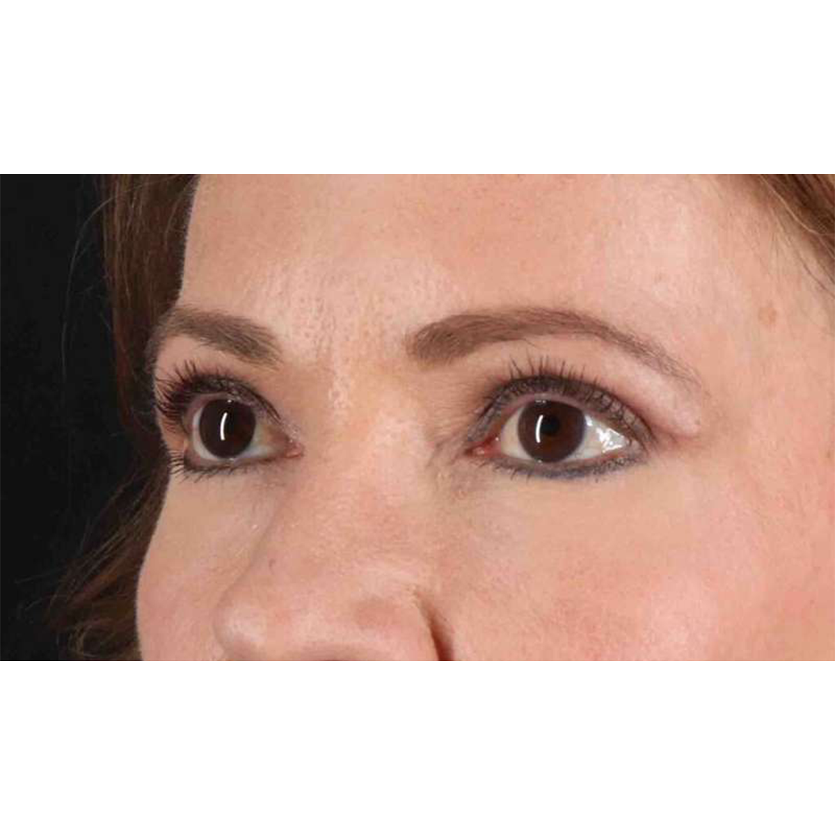 Eyelid Surgery Before & After Patient #1924