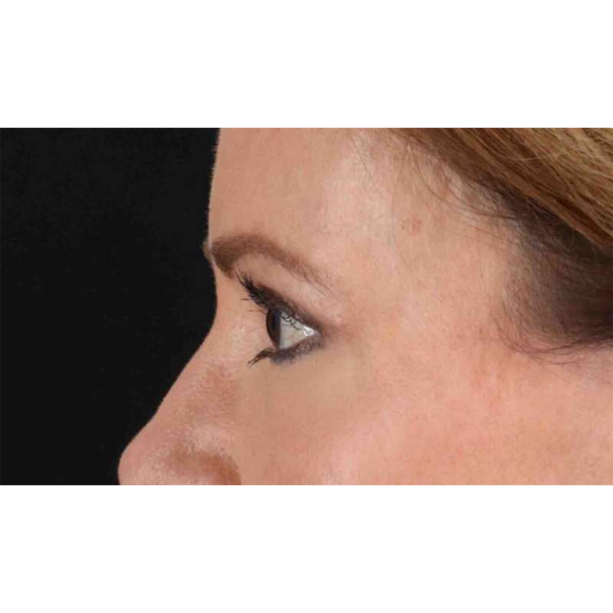 Eyelid Surgery Before & After Patient #1924