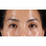 Eyelid Surgery Before & After Patient #1935