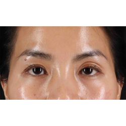 Eyelid Surgery Before & After Patient #1935