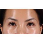 Eyelid Surgery Before & After Patient #1935