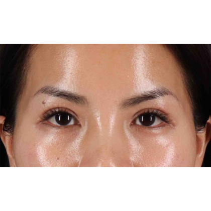 Eyelid Surgery Before & After Patient #1935