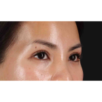 Eyelid Surgery Before & After Patient #1935