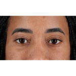 Eyelid Surgery Before & After Patient #1946