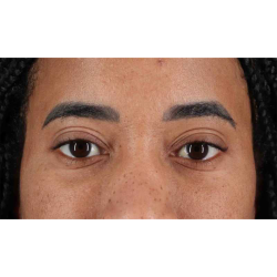 Eyelid Surgery Before & After Patient #1946
